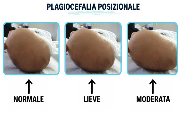 plagiocefalia